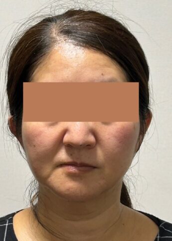 顎変形症手術 顔の変化　アラ50施術後